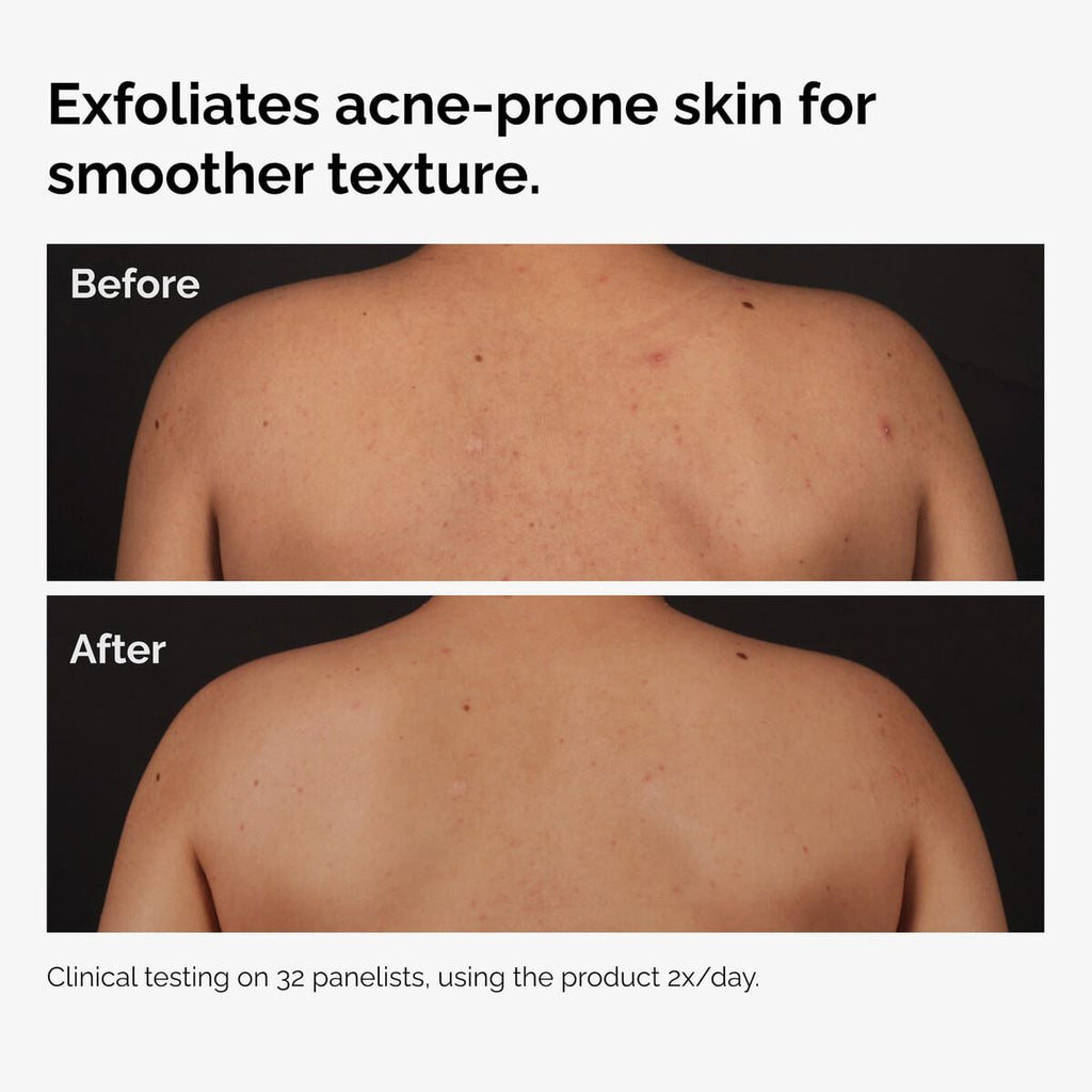 Salicylic Acid 0.5% Body Serum Targeted Serum Care